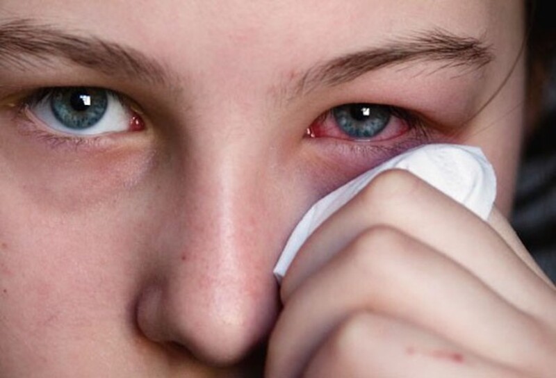 Cắt mí hỏng là một trong những nguyên nhân dẫn đến hở mí mắt nghiêm trọng