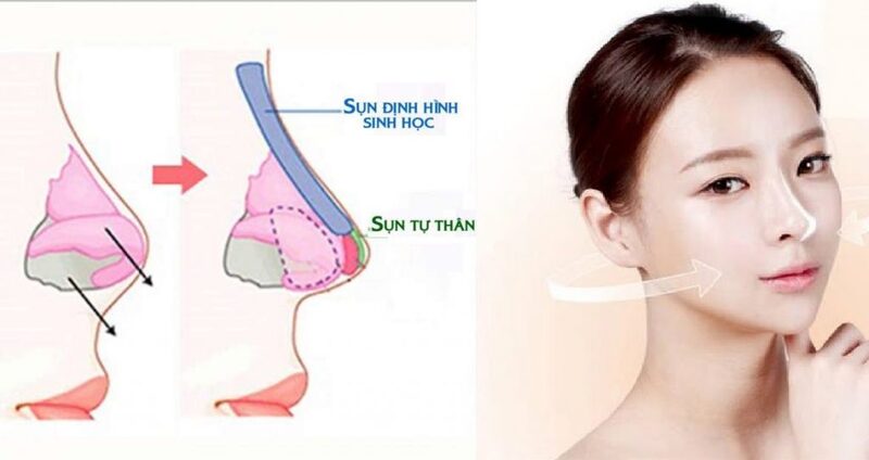 Các bác sĩ đánh giá cao về phương pháp bọc đầu mũi bằng sụn Megaderm hơn sụn tai