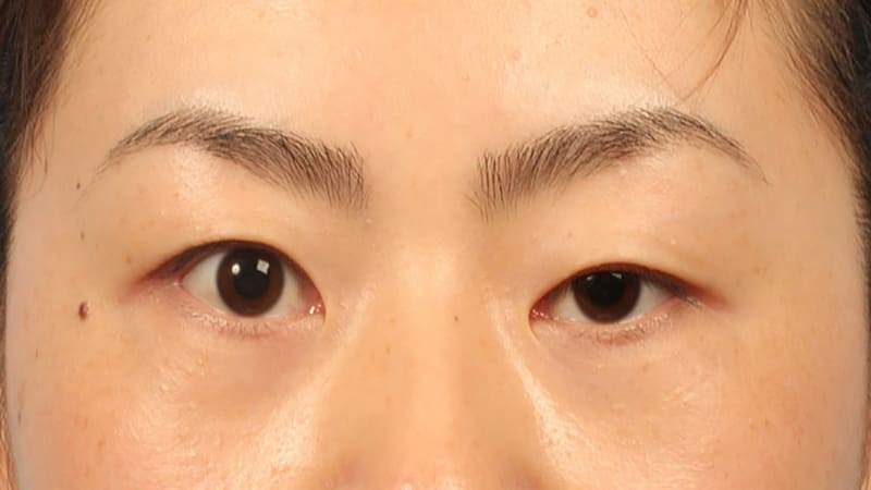 Tình trạng mí mắt sụp, trợn trừng có thể gặp phải khi cắt mí ở độ tuổi dưới 18