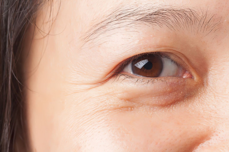 Người trong độ tuổi trung niên có nhiều nếp nhăn ở mí mắt nên tiến hành can thiệp cắt mí