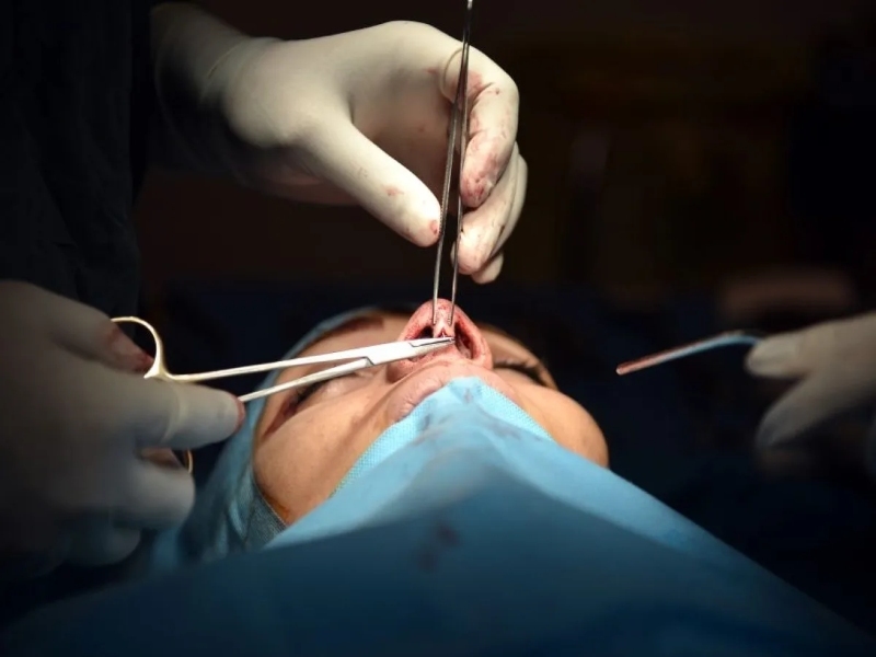 Kỹ thuật tay nghề của bác sĩ kém dễ dẫn đến việc hệ lụy làm tụt sống đầu mũi 