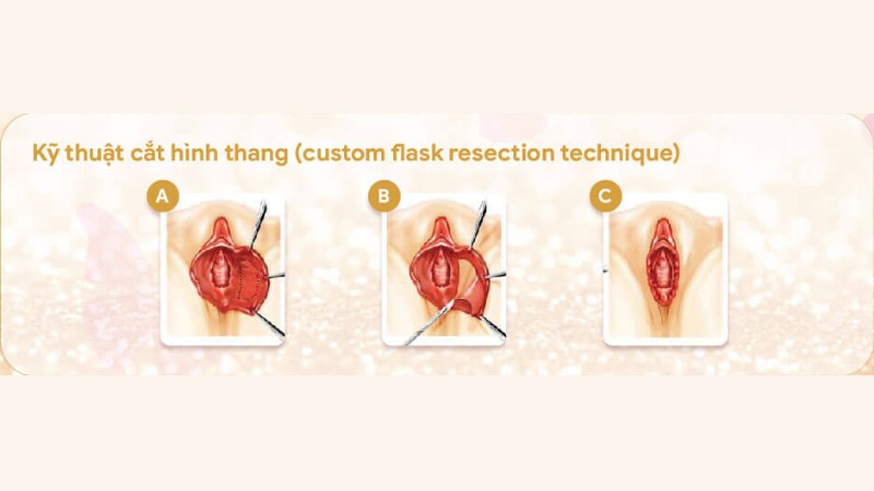 hình ảnh cắt môi bé bằng kỹ thuật custom flask resection technique