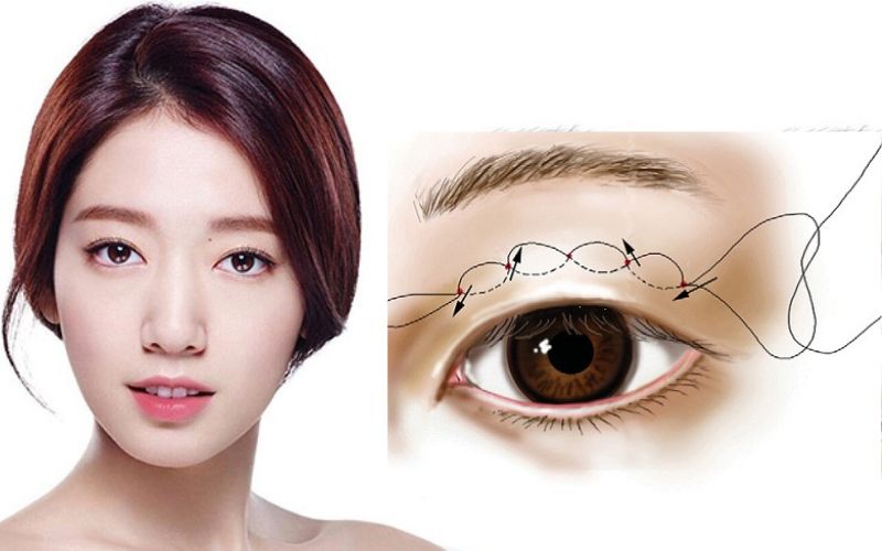 Nhấn mí mắt là phương pháp tạo hình đôi mắt 2 mí sắc nét mà không cần phẫu thuật