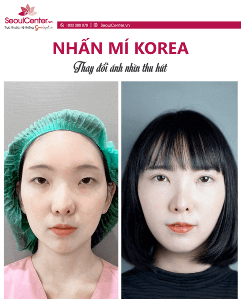 Đôi mắt của bạn gái có điểm nhấn hơn sau khi nhấn mí Hàn Quốc