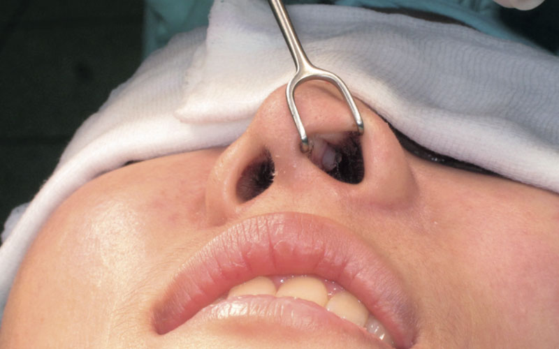 Tháo sụn nâng mũi là cách khắc phục biến chứng nhiễm trùng nặng nề