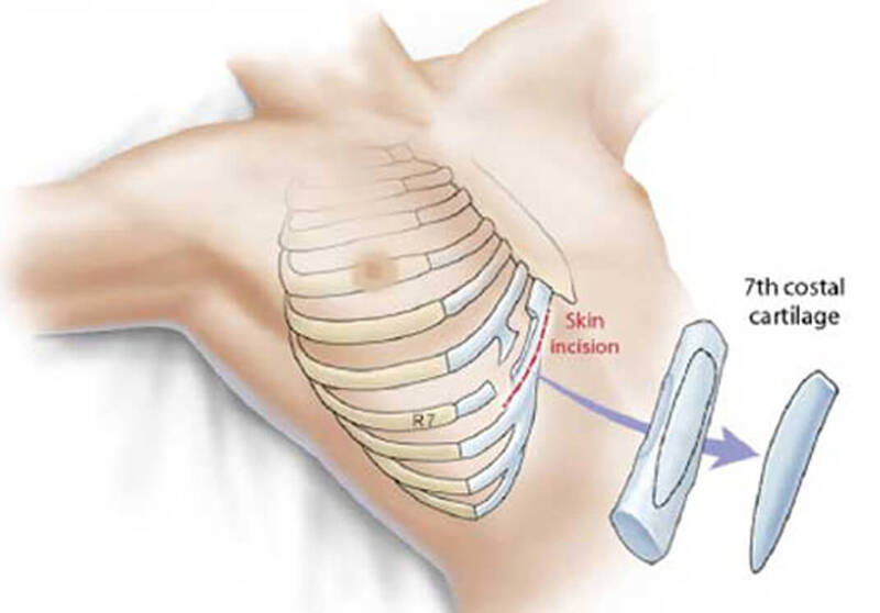 Sụn sườn nâng mũi được lấy tại vùng sụn 6, 7, 8 ở ngực bên phải