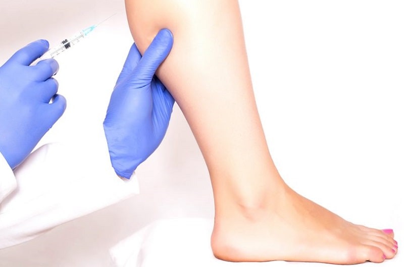Nhiều người có bắp chân to cần tiêm botox để chân thon thả hơn