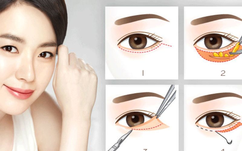 Phương pháp cắt mí Perfect Eyes khắc phục được nhiều khuyết điểm của đôi mắt