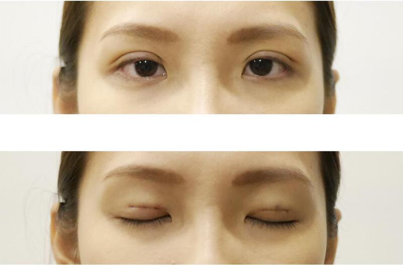 Nhấn mí mắt là phương pháp giúp sở hữu đôi mắt 2 mí mà không cần phẫu thuật