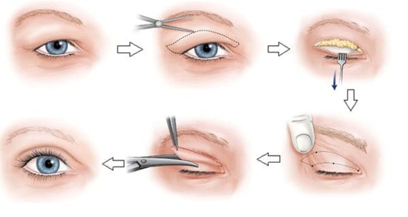 Tiểu phẫu cắt mí mắt là phương pháp tạo nếp 2 mí đơn giản