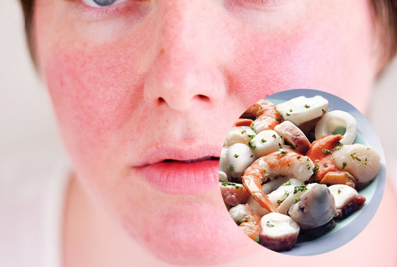 Khi ăn hải sản mũi có thể gặp phải tình trạng kích ứng vô cùng nghiêm trọng