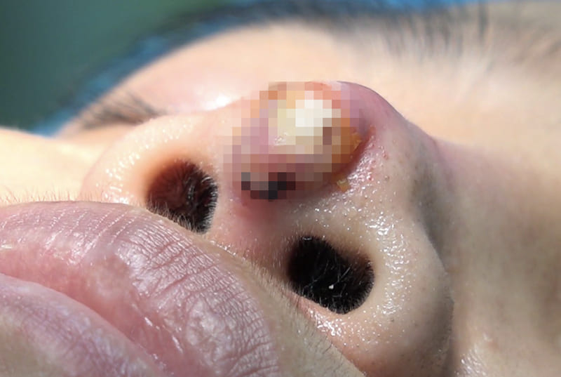 Chóp mũi bị sưng đỏ và lộ sụn nâng ra bên ngoài
