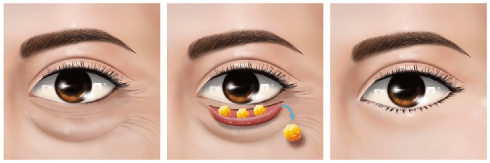 Trước và sau tiểu phẫu lấy mỡ mí mắt dưới
