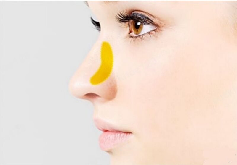 Chất liệu sụn nâng khi dựng trụ mũi có độ tương thích với cơ thể rất cao