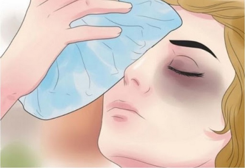 Chườm đá để giảm sưng tấy sau nâng mũi bị bầm mắt rất hiệu quả