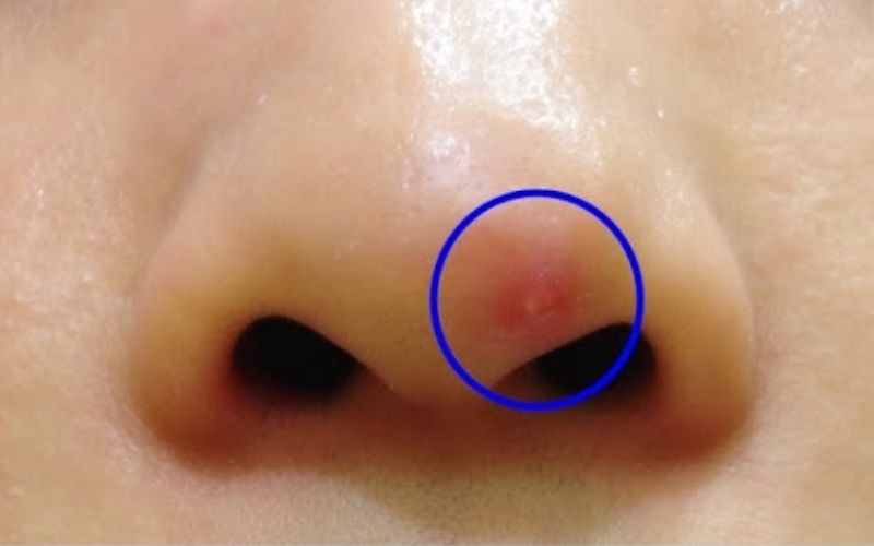 Vết khâu nâng mũi có mủ gây nhiễm trùng nghiêm trọng và cần chữa trị