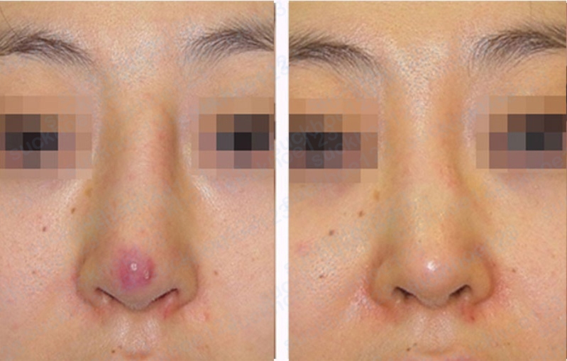 Bạn có thể phát hiện sớm mũi sau khi nâng bị viêm, nhiễm trùng bằng một số dấu hiệu