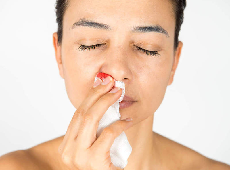 Sụn nâng mũi không đảm bảo chất lượng là nguyên nhân gây nhiễm trùng