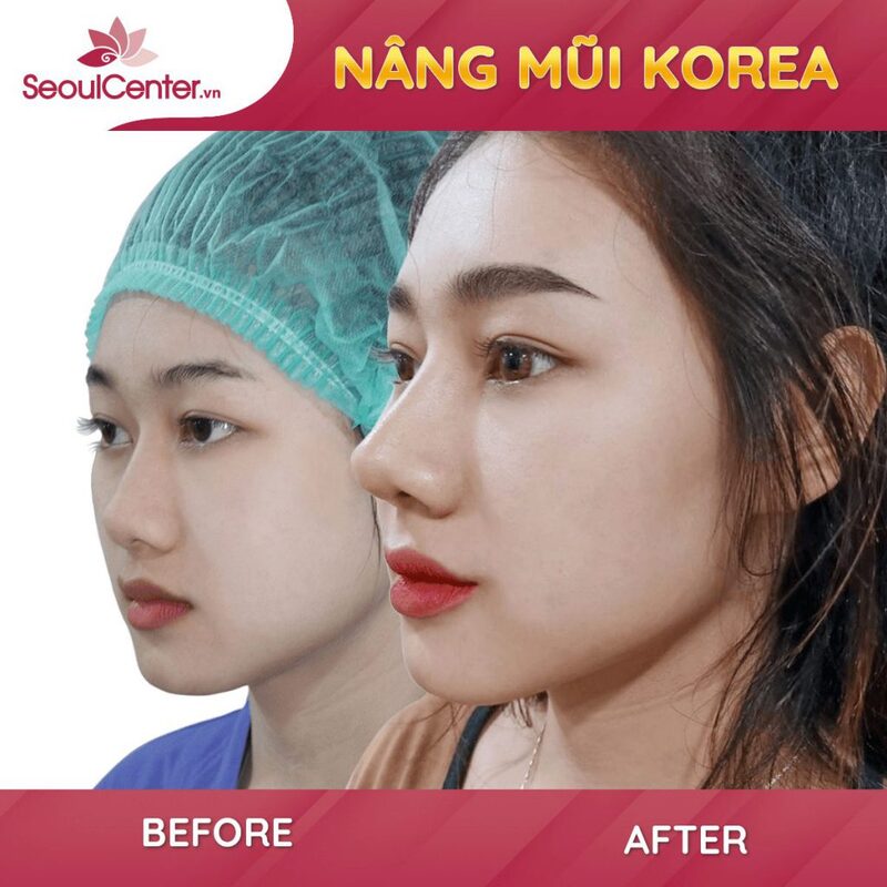 Phương pháp nâng mũi Hàn Quốc giúp khắc phục sống mũi thấp tẹt