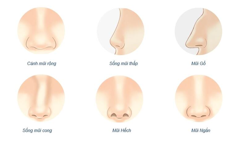 Phương pháp dành cho những người mũi nhiều khuyết điểm