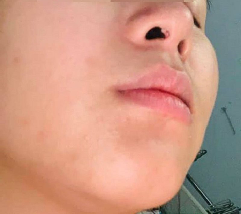 Nâng mũi bị nổi cục trong lỗ mũi