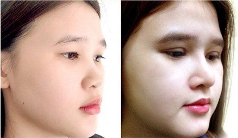 Nâng mũi implant giúp thu gọn đầu mũi và giúp dáng mũi đẹp hơn