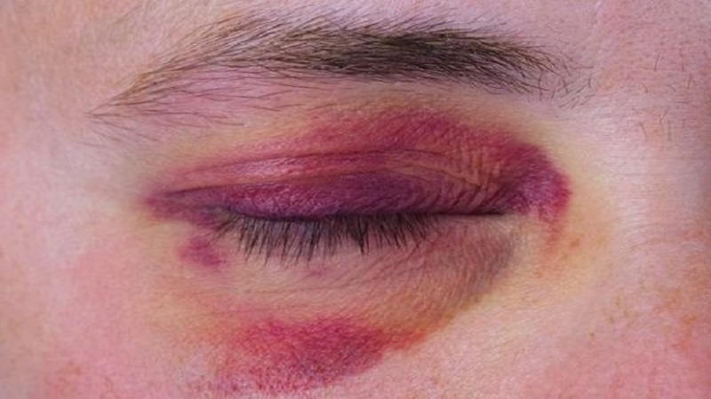 Tụ máu bầm sau khi thực hiện thẩm mỹ mắt