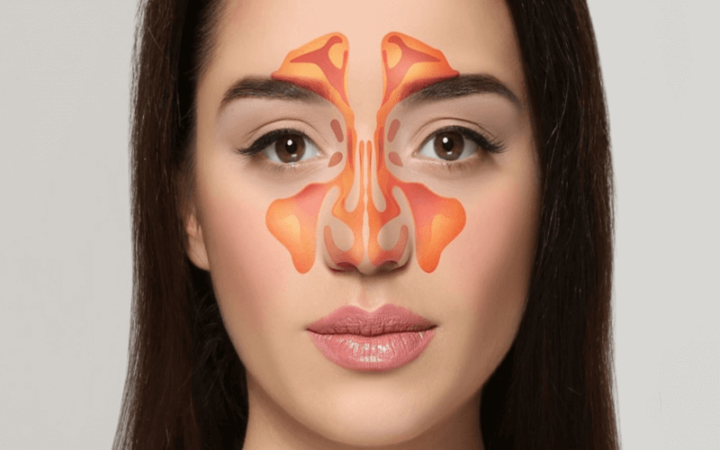 Bị viêm xoang nhẹ có thể nâng mũi bình thường