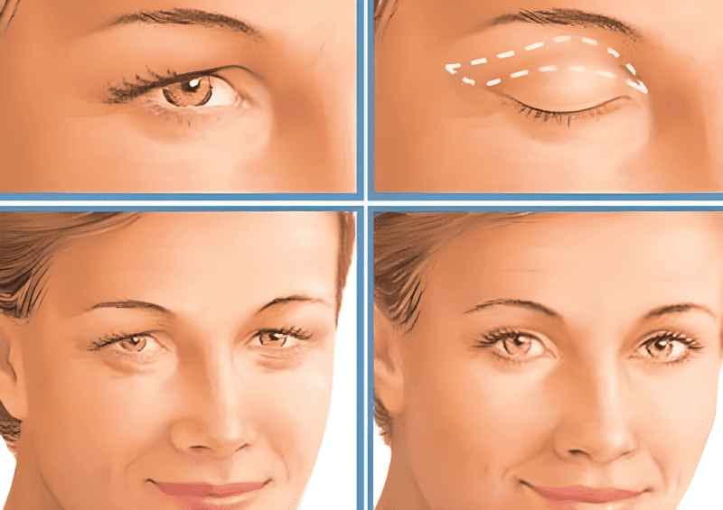 Cắt da chùng mí mắt giúp cải thiện thẩm mỹ cho khuôn mặt