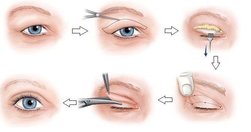Cắt mí mắt full là phương pháp thẩm mỹ mí mắt đơn giản mang đến đôi mắt đẹp 2 mí