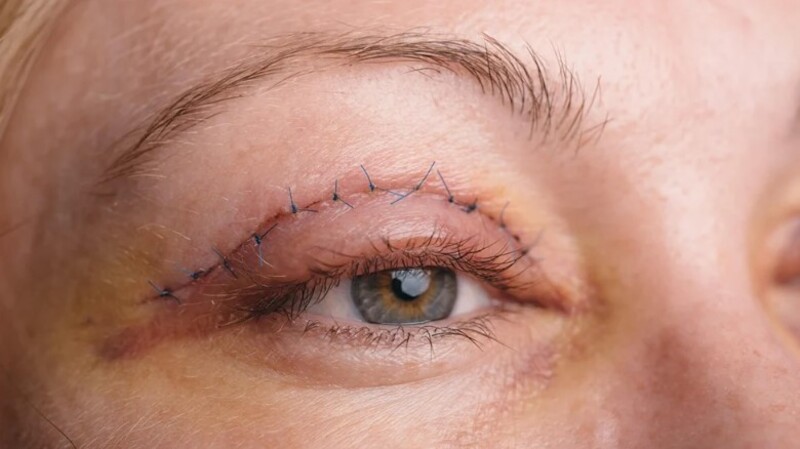 Nhiều người lo lắng tác hại cắt mí mắt khi về già