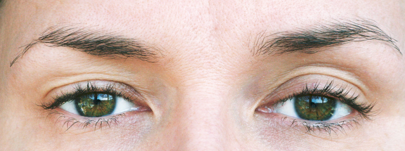 Mí mắt bị lệch do nhiều nguyên nhân có thể do bẩm sinh hoặc chế độ sinh hoạt không khoa học