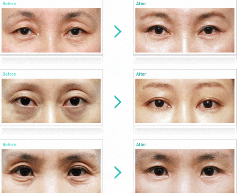 Cắt bọng mắt để cải thiện vùng da mắt có dấu hiệu lão hóa và nhăn nheo