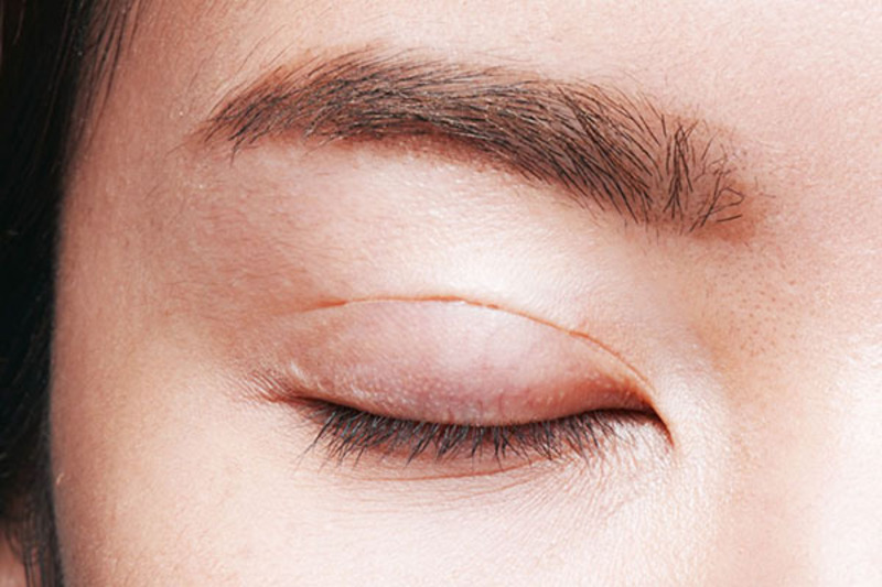 Phương pháp phẫu thuật lấy mỡ mí mắt và cắt da thừa trở nên phổ biến 