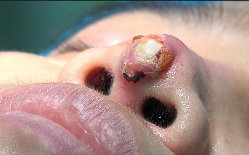 Nâng mũi có thể gặp tình trạng vết thương viêm, nhiễm trùng trong giai đoạn hậu phẫu