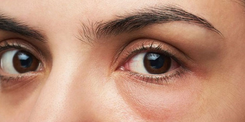 Bọng mắt xuất hiện làm giảm nhan sắc vốn có của khuôn mặt