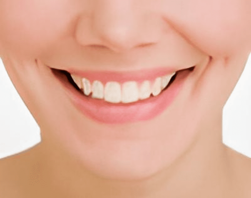 Cải thiện môi lệch khi cười giúp tự tin hơn