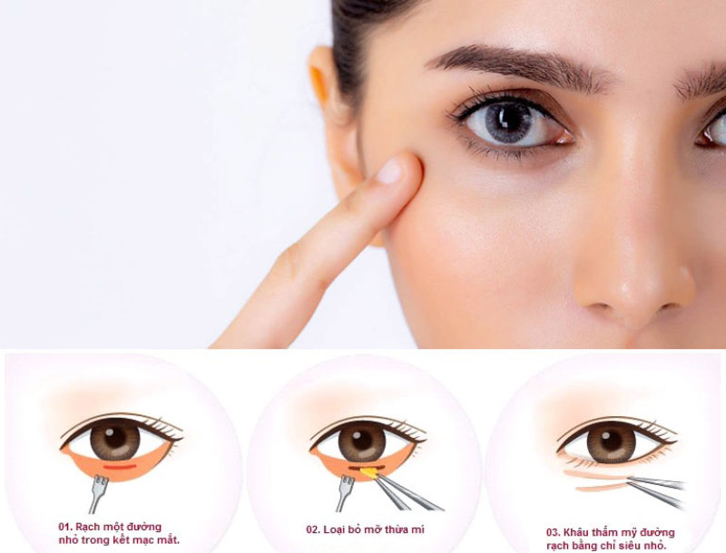 Cắt mí mắt cần đo đạc chính xác, thao tác dứt khoát để tránh xuất hiện biến chứng nguy hiểm
