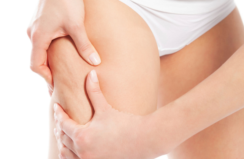 Mỡ mềm thường xuất hiện trên cánh tay, đùi, mông