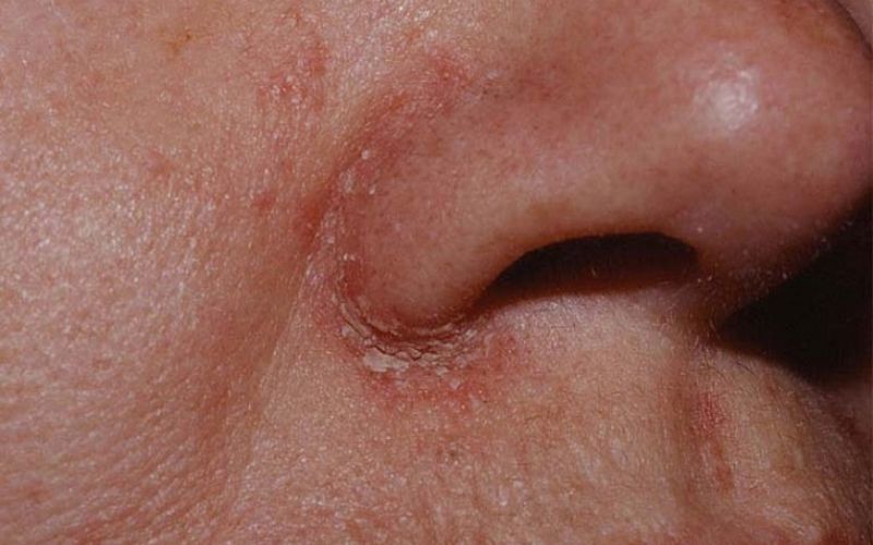 Vết khâu nâng mũi đóng vảy là hiện tượng thường gặp sau khi nâng mũi