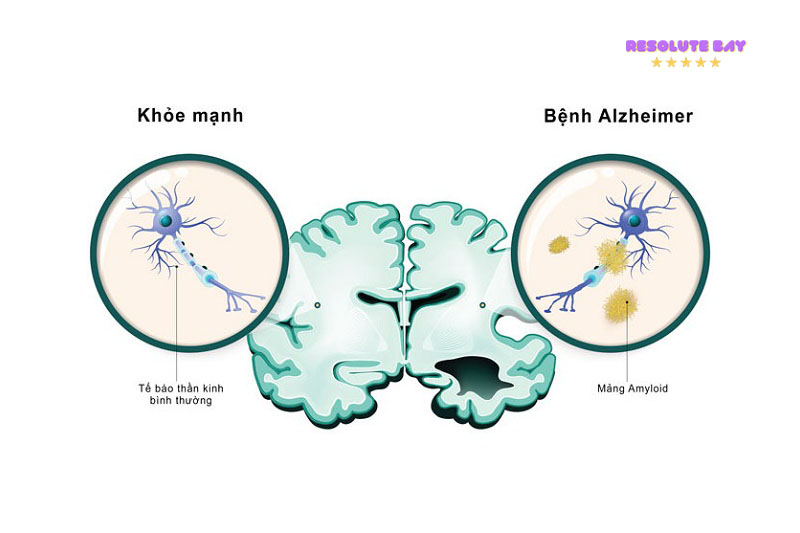 Bệnh Alzheimer là gì