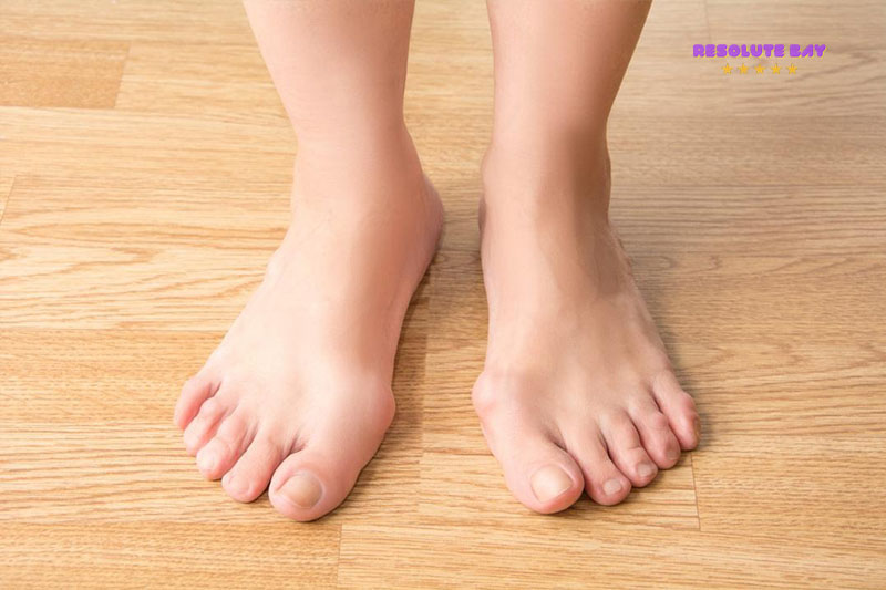 Chẩn đoán biến dạng ngón chân cái