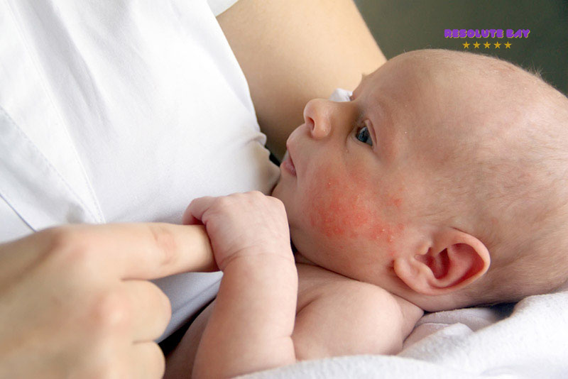 Nguyên nhân gây dị ứng sữa công thức ở trẻ sơ sinh