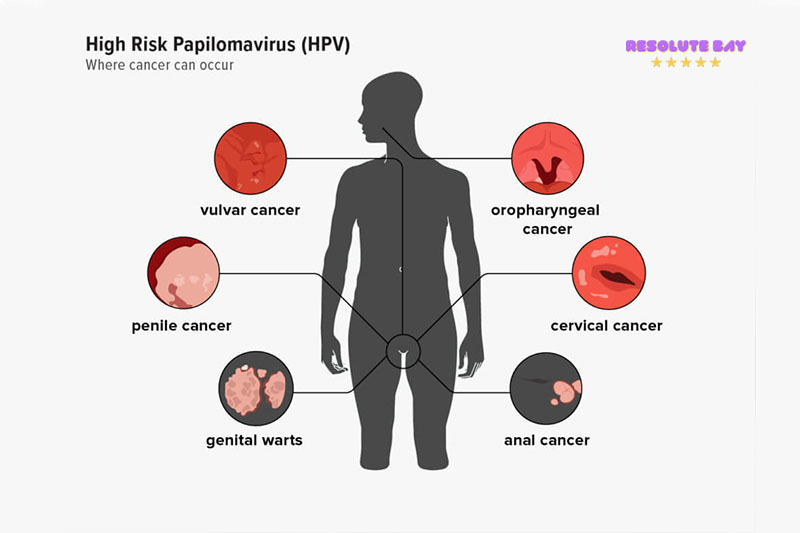 Nhiễm trùng Papilloma ở người là gì?
