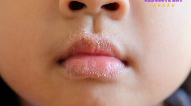 Đâu là những nguyên nhân gây nứt nẻ môi, khô môi ở bé?