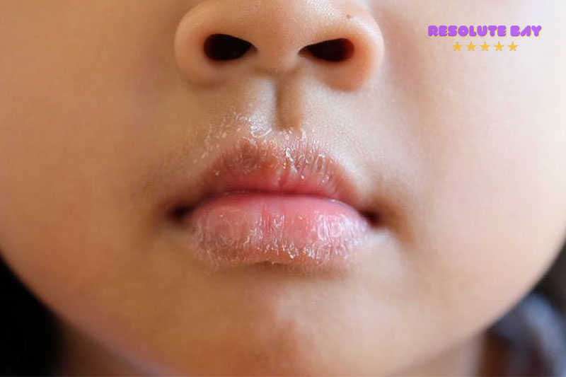 Đâu là những nguyên nhân gây nứt nẻ môi, khô môi ở bé?