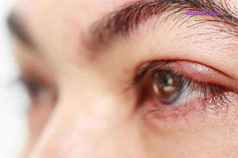 Sự khác nhau giữa mụt lẹo ở mí mắt và viêm mí mắt