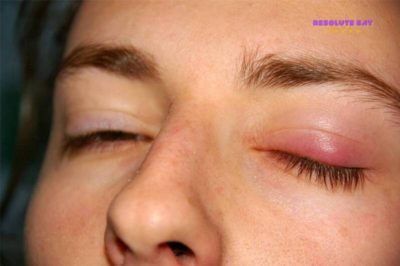 Dấu hiệu và triệu chứng của viêm mí mắt