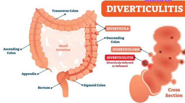 Viêm túi thừa là gì