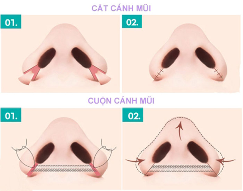 Các phương pháp thu gọn cánh mũi phổ biến hiện nay